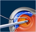 eye-cataract-surgery-diagram (2)