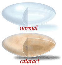 Cataracts_After_LASIK.png